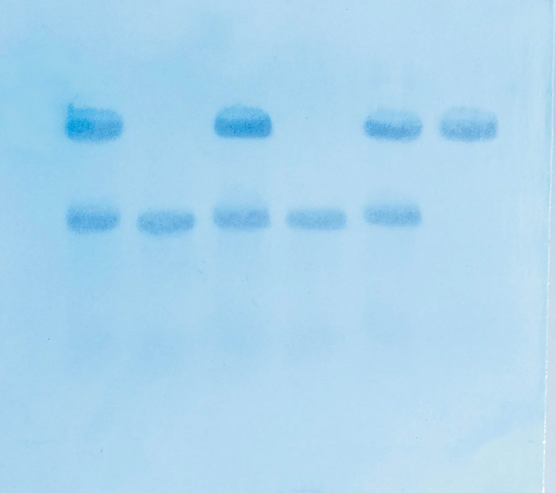In Search of the Sickle Cell Gene by Southern Blot - Kormay Biomedicals store